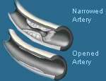 cardiac catheterization