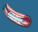 cardiac catheterization