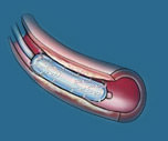 cardiac catheterization