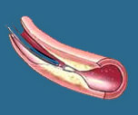 cardiac catheterization